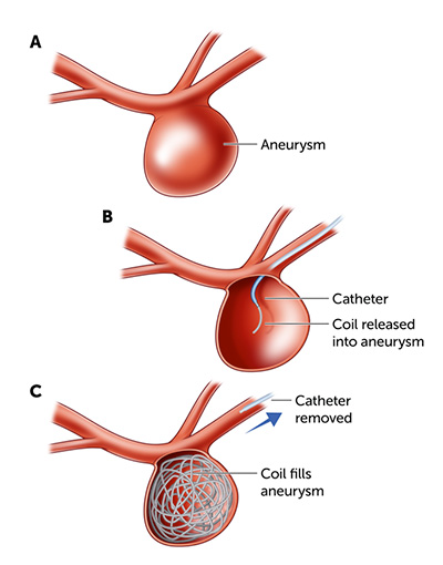 Thin metal wire inserted through the artery and coiled into the aneurysm