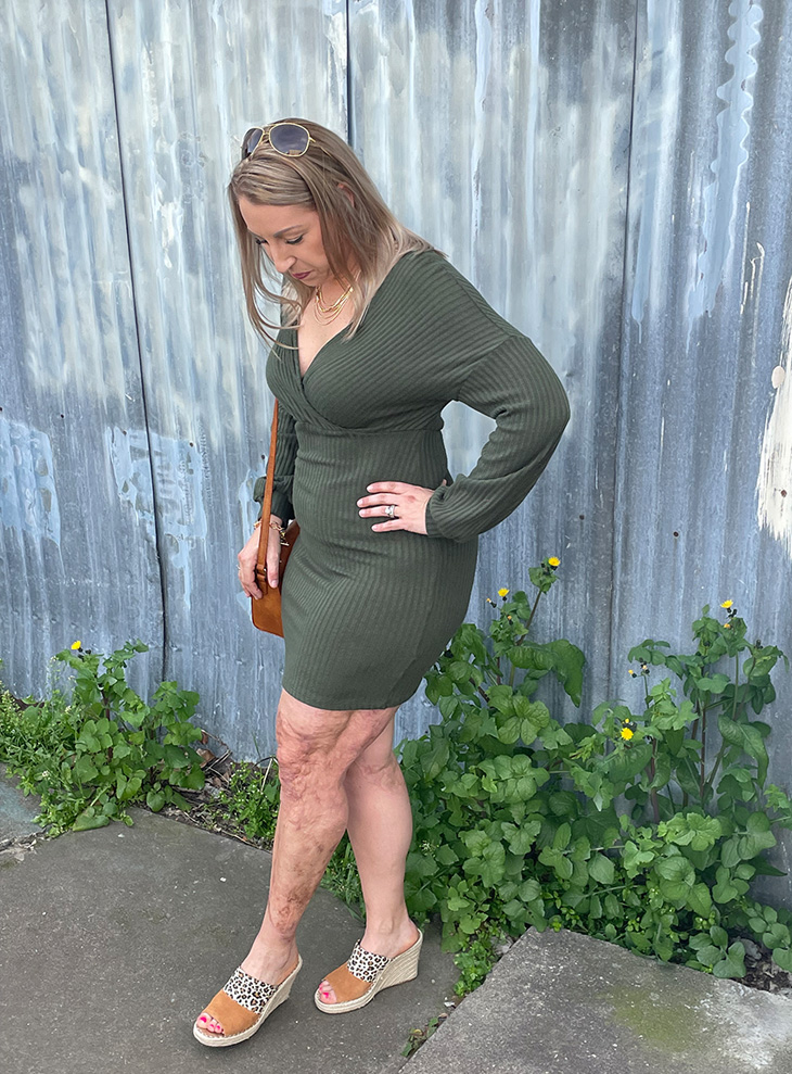  Woman wearing green dress poses for photo looking down at scarred legs.