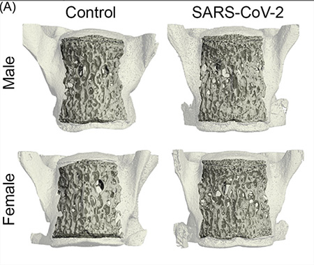 3D renderings of L5 lumbar spine segments showing SARS-CoV-2 induced systemic bone loss in both male and female mice.