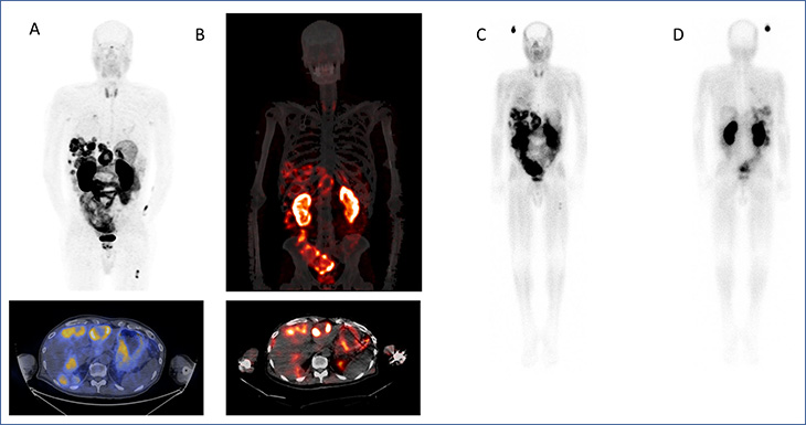Four images of a pancreatic cancer patient before treatment and after treatment as well as two images of a pancreas with cancer before and after treatment.