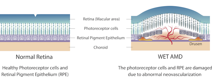 An illustration of a normal retina compared to a retina with wet AMD. The normal retina shows a flat layer of cells lining the eye and the wet AMD retina shows a branching blood vessel extending into and pushing up the cell layer. 