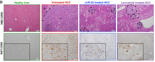 Eight images show mouse tissue from a healthy liver, untreated liver cancer, treatment with miR-22 and treatment with lenvatinib. 