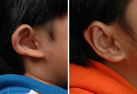 Ear before and after composite 