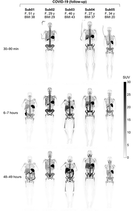 Full-body scans of five COVID-19 recovering patients at time 30-60 minutes, 6 to 7 hours, and 48-49 hours after the radiotracer injection.