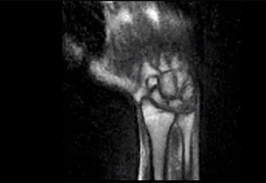 An MRI scan of a person’s wrist 
