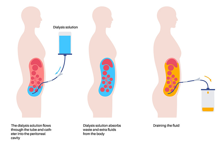An illustration showing an IV bag of blue dialysis solution that goes into the abdomen, then a tube goes from the abdomen into a yellow container