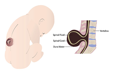 Spina bifida depicted with baby on the left and the spine on the right