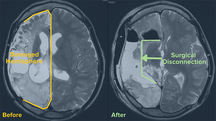 side by side MRI images – which shows the damaged hemisphere pre-op and the brain after surgery