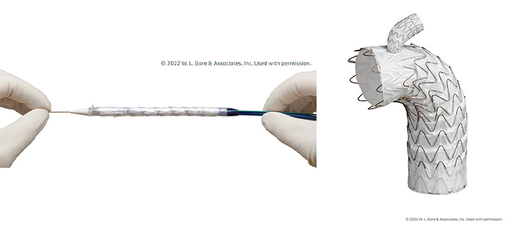Two images of a white and silver stent graph, one stretched out with gloved hands at each end, one sitting upright. 
