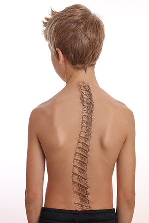 A child’s back with scoliosis