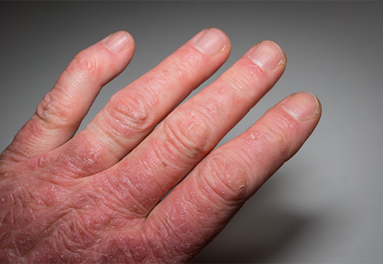 A close-up photo of a person&#x2019;s left hand with red blisters on the skin and swollen fingers