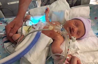 A baby in a hospital bed with tubes in his throat.