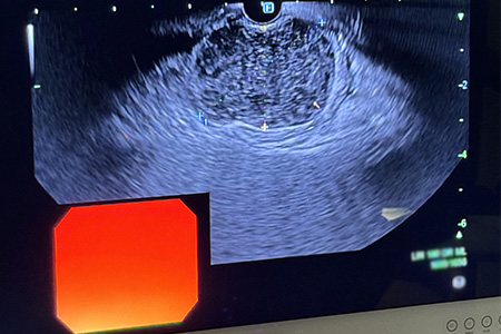 Ultrasound monitor with view of pancreas on the screen.