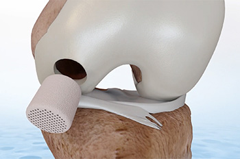 Image of CartiHeal™ Agili-C™ Cartilage Repair Implant, white cork-shaped object that fits into hole in bone. 