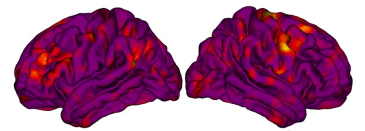 Two MRI scans of human brains highlighted in purple, red and yellow show different widths of the cortex.