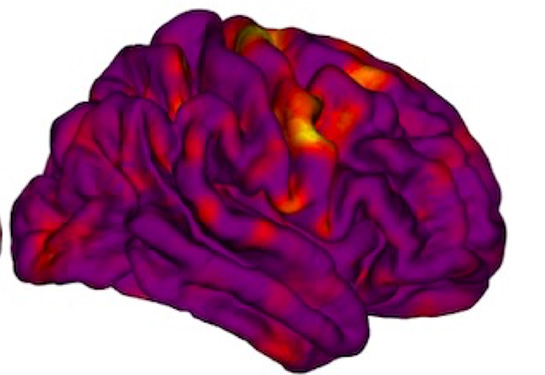 An MRI scan of a human brain highlighted in purple, red and yellow shows different widths of the cortex. 