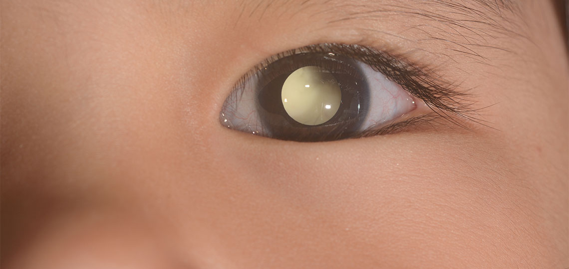An example of leukocoria where the eye reflects a yellowish color instead of red. 