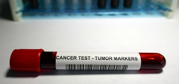 test tube marked cancer test - tumor markers