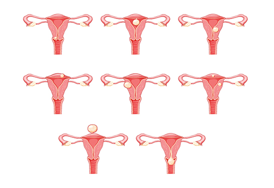 Un diagrama de fondo blanco muestra serie de ocho úteros, cada una con fibroma