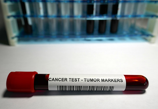 test tube marked cancer test - tumor markers