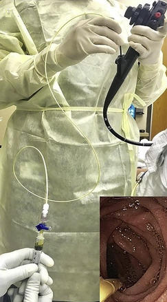 Person in yellow scrubs holding scope with small picture in bottom, right corner showing inside of intestine.