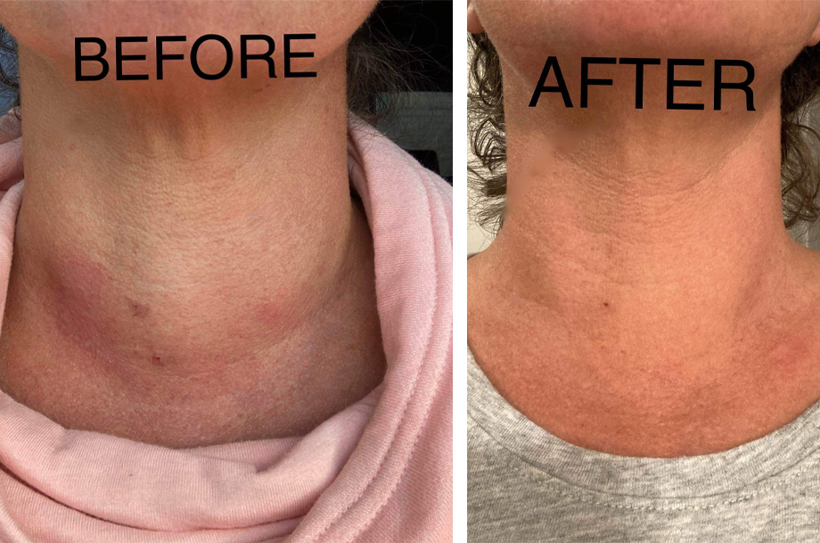 Side-by-side images of patient's neck; the left one with noticeable swelling in the neck, the right one with no swelling