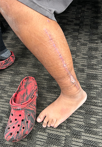 Large scar on outside of calf with red and black shoe next to person’s foot. 