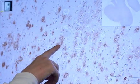 A hand pointing on a screen showing brown spots on a purple background