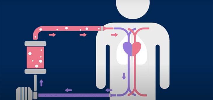 diagram of how the ECMO machine works