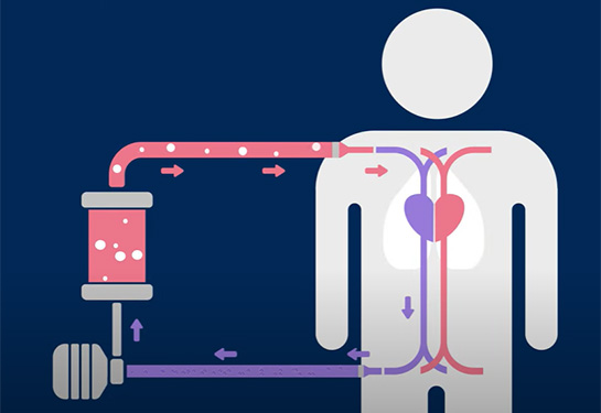 How ECMO works