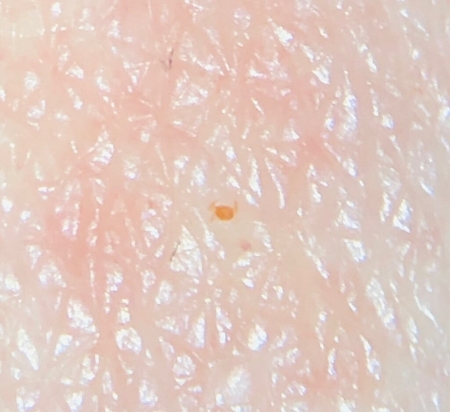 tiny insect on human skin