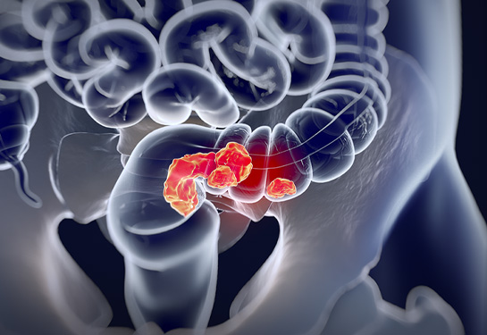 3D black-and-white illustration of colorectal cancer &#x2013; cancer is red and orange