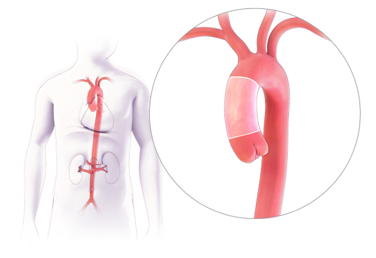 Drawn body with aortic artery in red and red aortic arch drawn to the right.