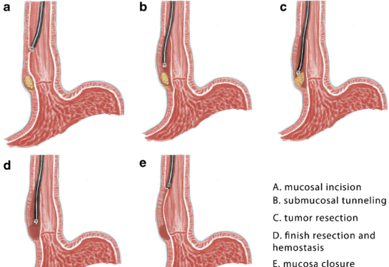 Chart shows illustration of five examples of stomach lining with tube going down the lining.