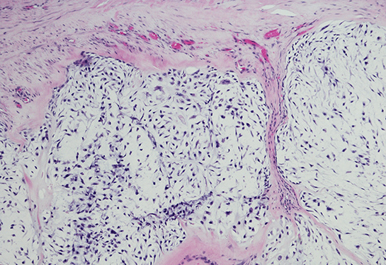 Micrograph of chondrosarcoma