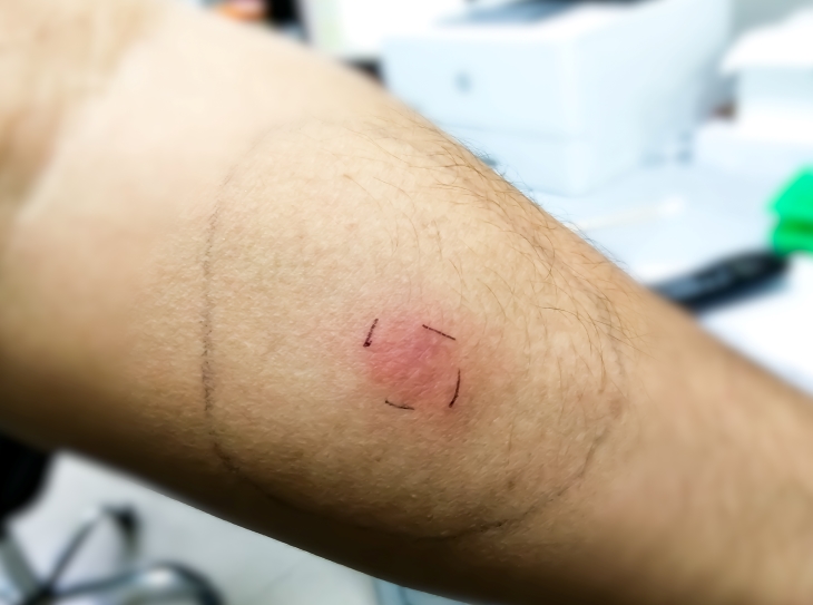 Close-up photo of patient's arm with ink marks next to a raised red spot on the skin and a larger, circled ink mark.