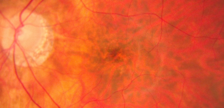 Close-up image of a human retina showing blood vessels, optic disc, and orange-red retinal tissue.