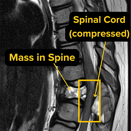 MRI image showing side view of a human spine. Labels identify a collapsing vertebra and compressed spinal cord.