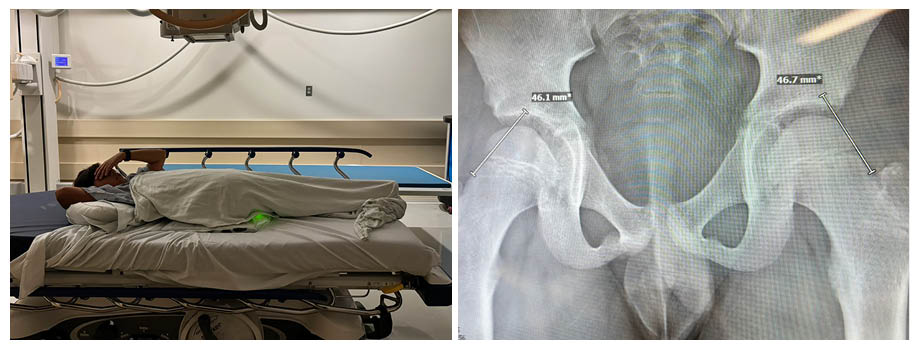Left to right: Child laying on x-ray table; x-ray of a pelvis, focusing on the hip