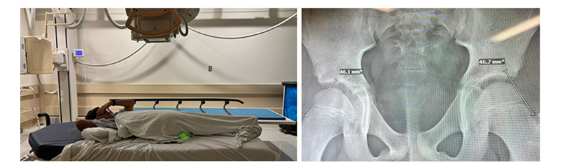 Left to right: Child laying on x-ray table; x-ray of a pelvis, focusing on the hip