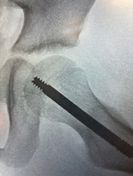 X-ray of a hip with a new orthopaedic device visible which screws to the hip and telescopes on itself to grow with the child