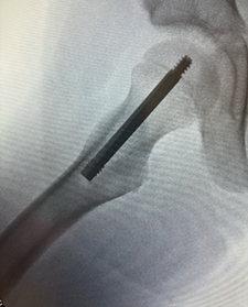 X-ray of the hip with a telescoping device to address SCFE.