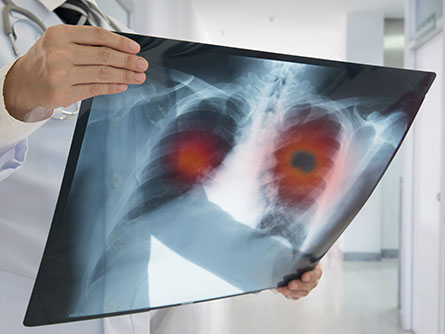 doctors looking at x-ray with lung cancer