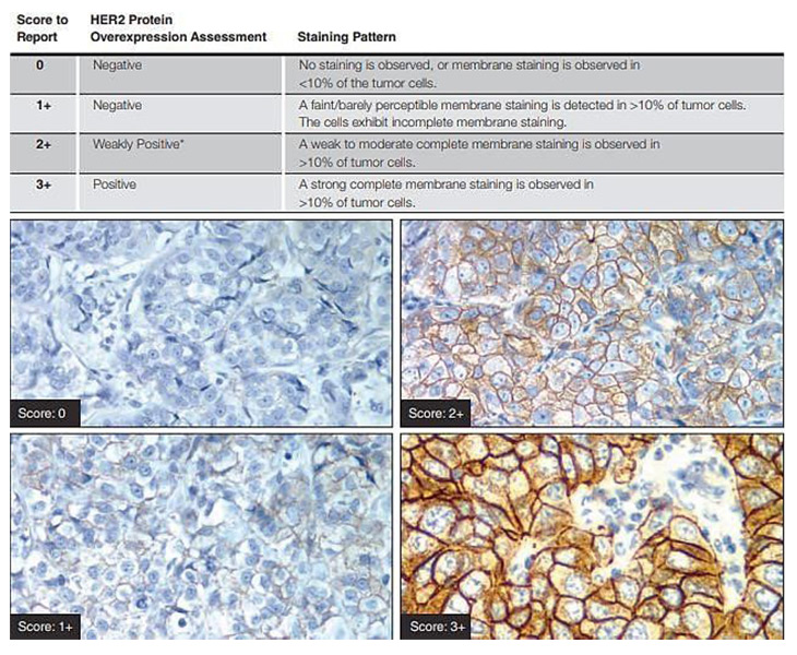 Breast Pathology Anatomy Model Kit, Breast Lesion Model