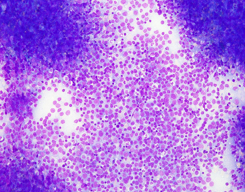 Bone marrow aspirate smear