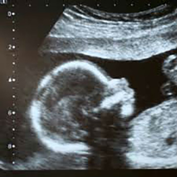ultrasound
