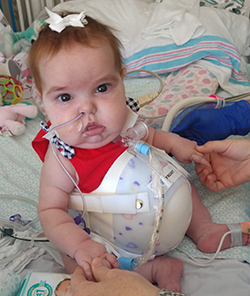 Patient born with organs outside of her abdomen receives transformative care