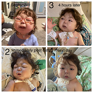 Zyllah before and after surgery.