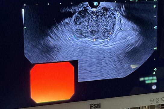 Endoscopic ultrasound image