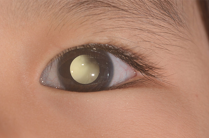 Eye with macular edema